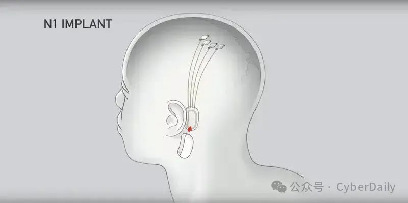 马斯克捐赠呼吸机_马斯克医疗美容医院_未来的医疗：马斯克揭示Neuralink在2025年计划为20至30名患者植入设备的理想